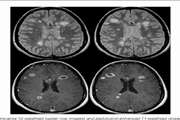 The relationship between enhanced plaques with Gadovist and Magnevist contrast brain magnetic resonance imaging and the neurological deficit in the acute phase of relapsing remitting multiple sclerosis